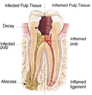 root canal 