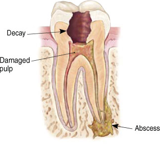 root canal 