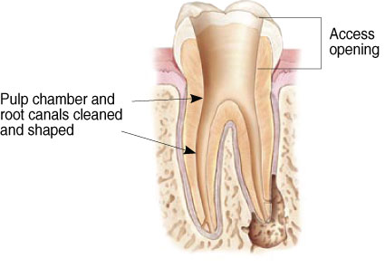 root canal 