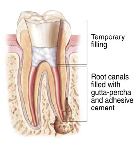 root canal 