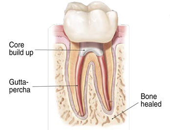 root canal 