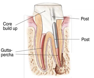 root canal 